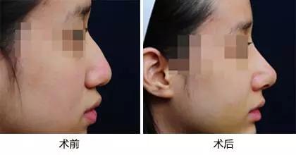 埋线鼻子vs假体隆鼻,隆鼻假体和埋线隆鼻