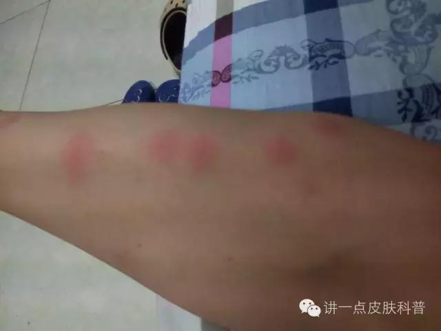 臭虫夜间出现每次打会减少吗,臭虫一般叮咬哪个部位