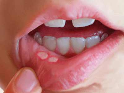 名老中医治经前口疮的经验,名医名方口腔溃疡