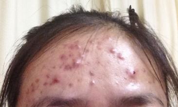 去掉额头上的痘痘用什么药膏,如何让额头上的痘痘消失