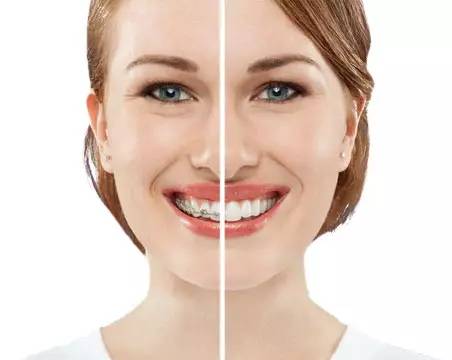 即使你放弃了牙齿矫正，也万不能投进“美容冠”的火坑