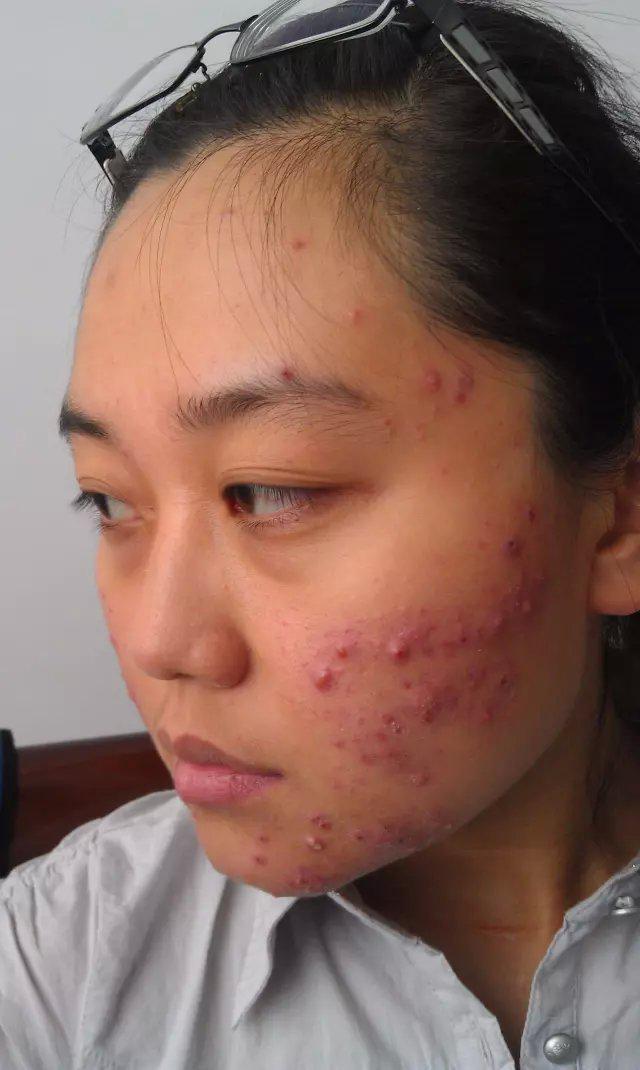 常年长痘的皮肤怎么调理回来,经常长痘如何快速消除