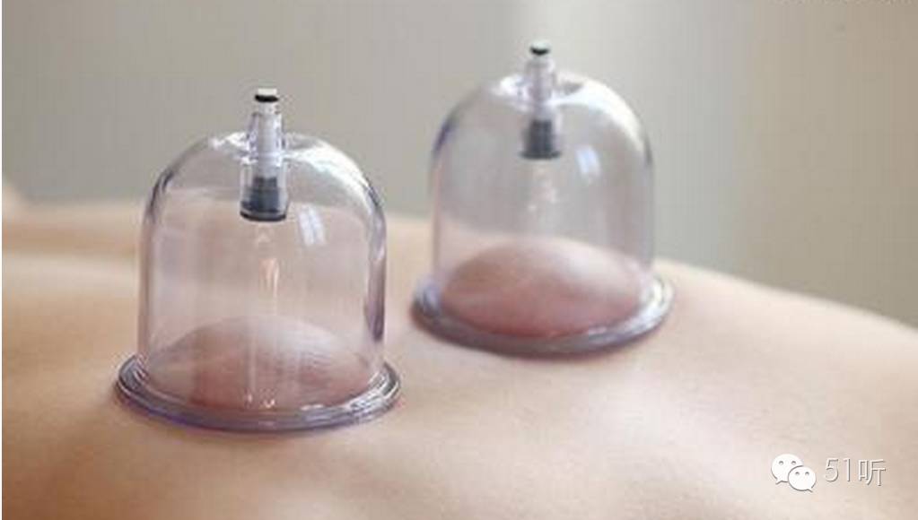 飞鱼菲尔普斯拔罐,飞鱼拔罐