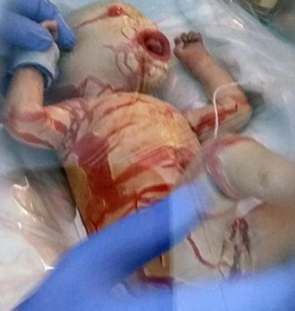 婴幼儿脖子花斑癣多久可以痊愈,婴儿花斑癣怎样算治好了