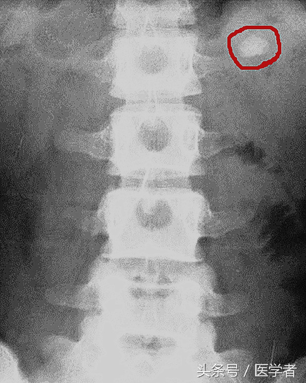 输尿管上段结石用哪种手术最好,输尿管狭小引起结石的治疗方法