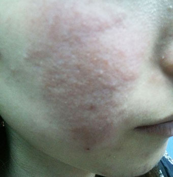 什么是激素过敏性皮炎,激素过敏性皮炎脸部图片