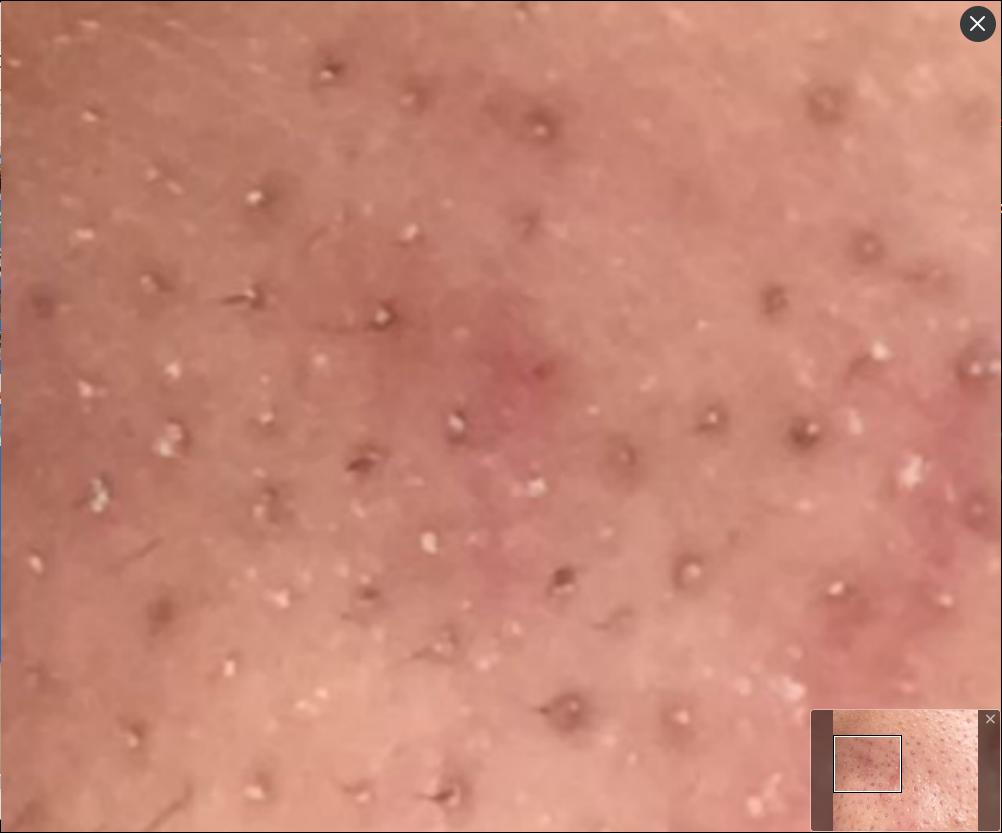 中医脸上反复长粉刺痘痘怎么调理,怎样去脸上粉刺和黑头粉刺