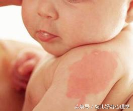 为什么有些婴儿会有胎记,为什么有的婴儿会有胎记