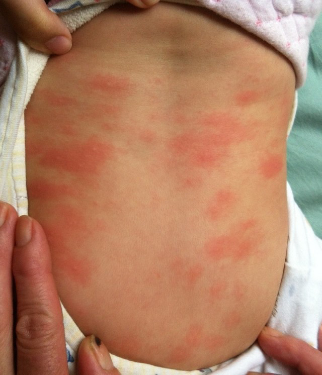 身上出现小红点是过敏吗,宝宝过敏起红疹需要吃过敏药吗