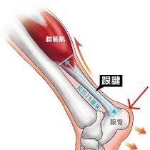止点性跟腱炎诊断,跟腱炎核磁鉴别诊断