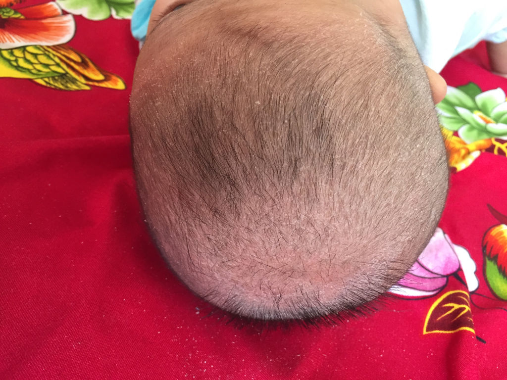 儿童脸上长白色癣中医辨证论治,小孩头上长癣状白皮屑中医