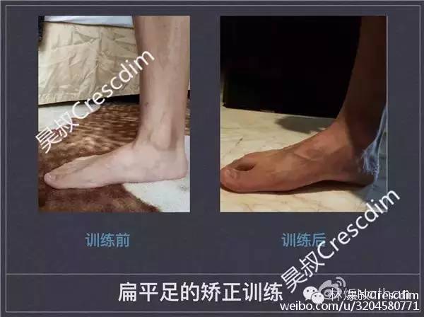 扁平足矫正训练法,扁平足物理治疗能不能恢复足弓