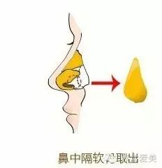 隆鼻太可怕怎么办,硅胶隆鼻正确方法图