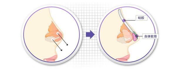 隆鼻太可怕怎么办,硅胶隆鼻正确方法图