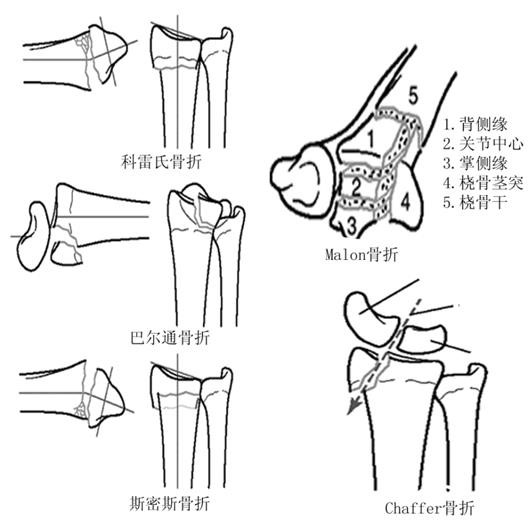 桡骨远端骨折传统石膏打法,成人桡骨远端骨折诊疗指南2023版