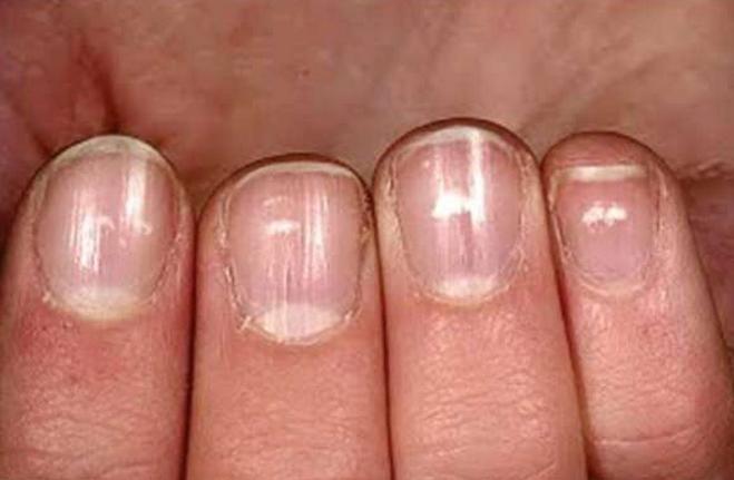 指甲上发现白点,指甲上有白点为什么要看皮肤科