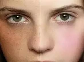 孕期长斑怎么办啊,孕期脸上长斑