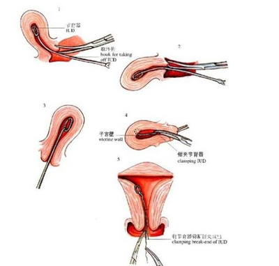 顺产还在出血可以上环吗,生孩子大出血后可以上环吗