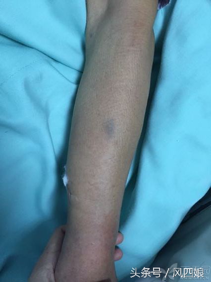 动脉采血后皮下出血怎么处理,动脉血管血肿如何消除