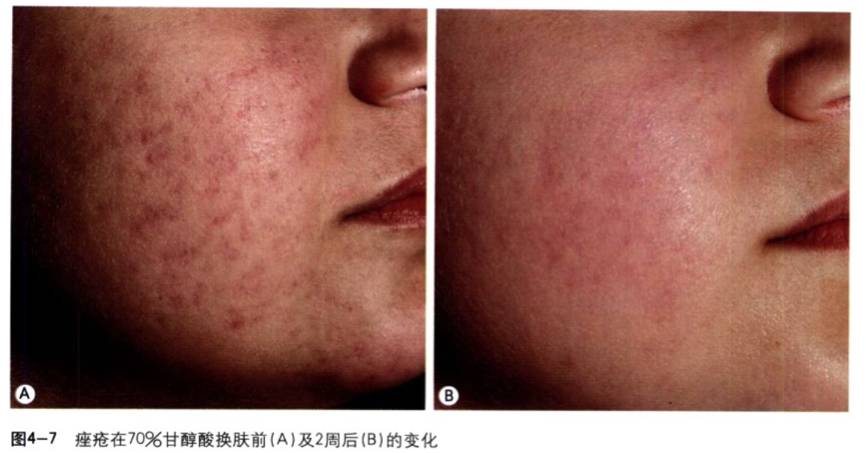 果酸换肤方法,果酸换肤让皮肤焕然一新