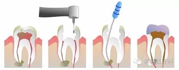 牙科精密附着体使用注意事项,开牙科诊所需要注意事项