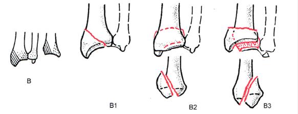 桡骨远端骨折传统石膏打法,成人桡骨远端骨折诊疗指南2023版