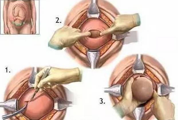 横切剖宫产后的疤痕,剖腹产横切和竖切二年愈合照片
