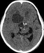 周忠清颅咽管瘤全切的终身复发率,周忠清谈颅咽管瘤术后寿命