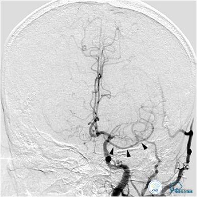 大脑中动脉侧支代偿正常标准,什么是左侧大脑中动脉代偿供血