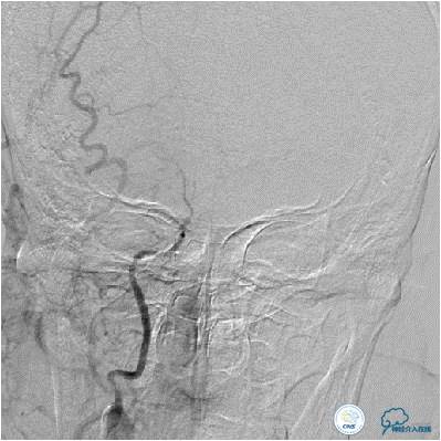 大脑中动脉侧支代偿正常标准,什么是左侧大脑中动脉代偿供血