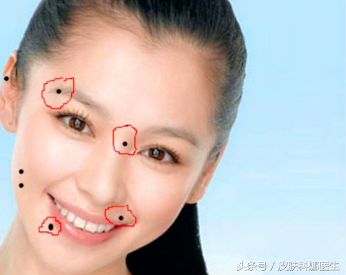 孩子脸上的痦子需要点掉吗,长在脸上的痦子图片大全
