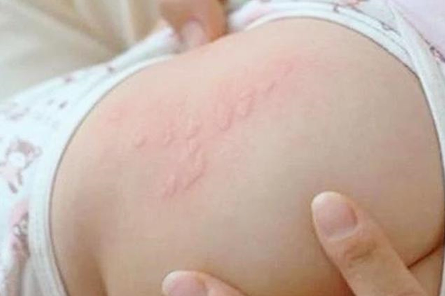 宝宝身上起了一块干燥起皮还有泡,宝宝身上起疙瘩破了还流水