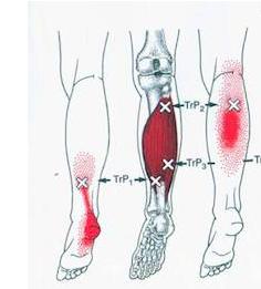 膝关节腘窝疼痛的锻炼方法,腘窝疼痛连带大腿小腿肌肉痛