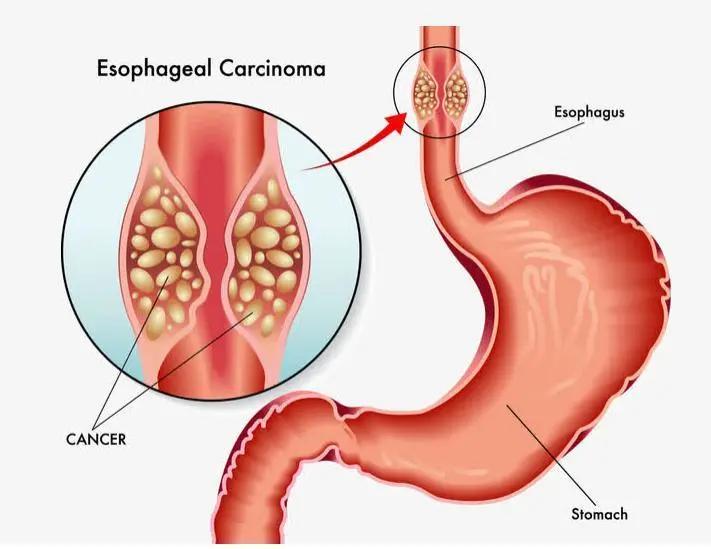 食管有没有异物做什么检查,食管不舒服挂什么科看病