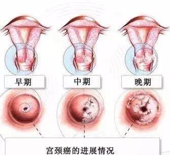 绝经了还需要妇科检查吗？