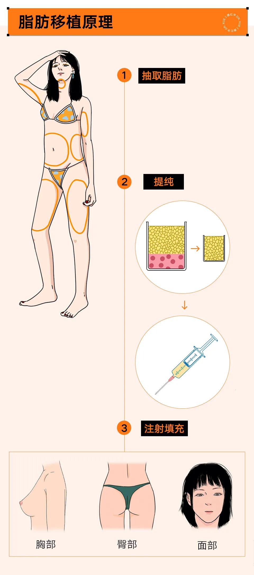自体脂肪移植后的图片,自体脂肪移植丰胸丰臀