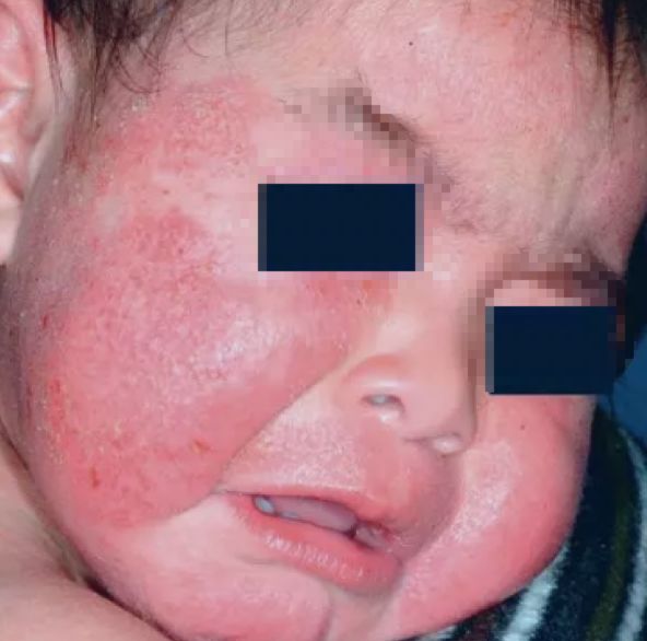 十大湿疹药膏不含激素纯中药,婴儿湿疹膏不含激素十大排行榜