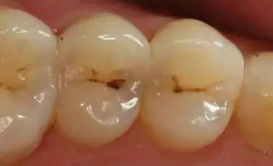 补牙是把牙洞都填平了吗,为啥补牙要把小洞变大
