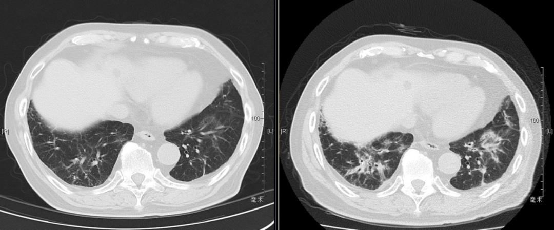 阵发性房颤和用药有关系吗,房颤药物控制好了还会复发吗
