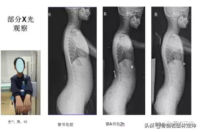 对孩子脊柱好的书包,书包对脊柱侧弯的影响