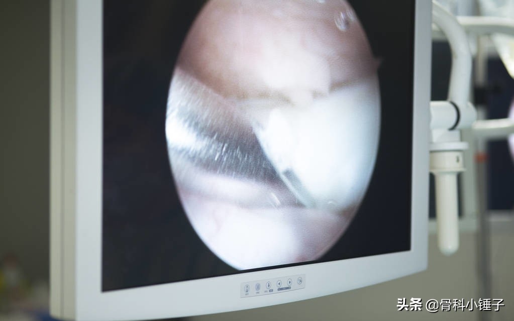 前后交叉韧带损伤自测,前交叉韧带损伤能蹲吗