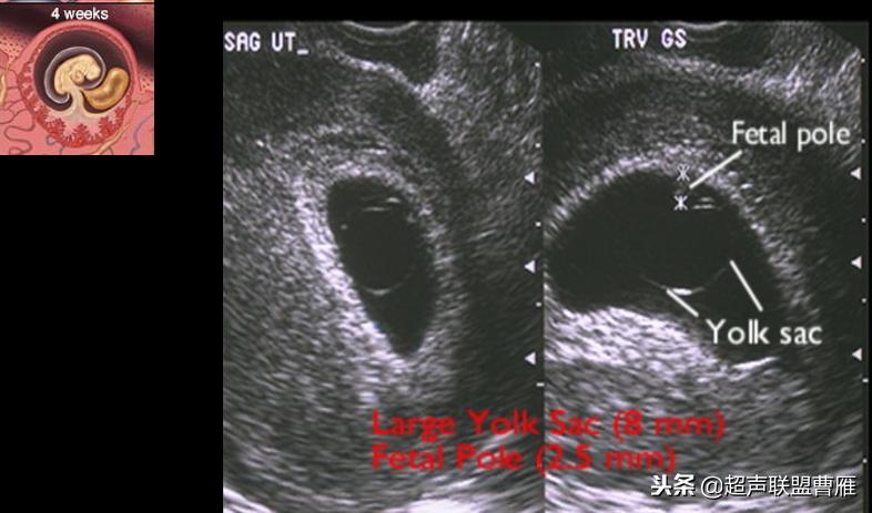 3毫米卵黄囊未见胎芽正常么,40多天的卵黄囊