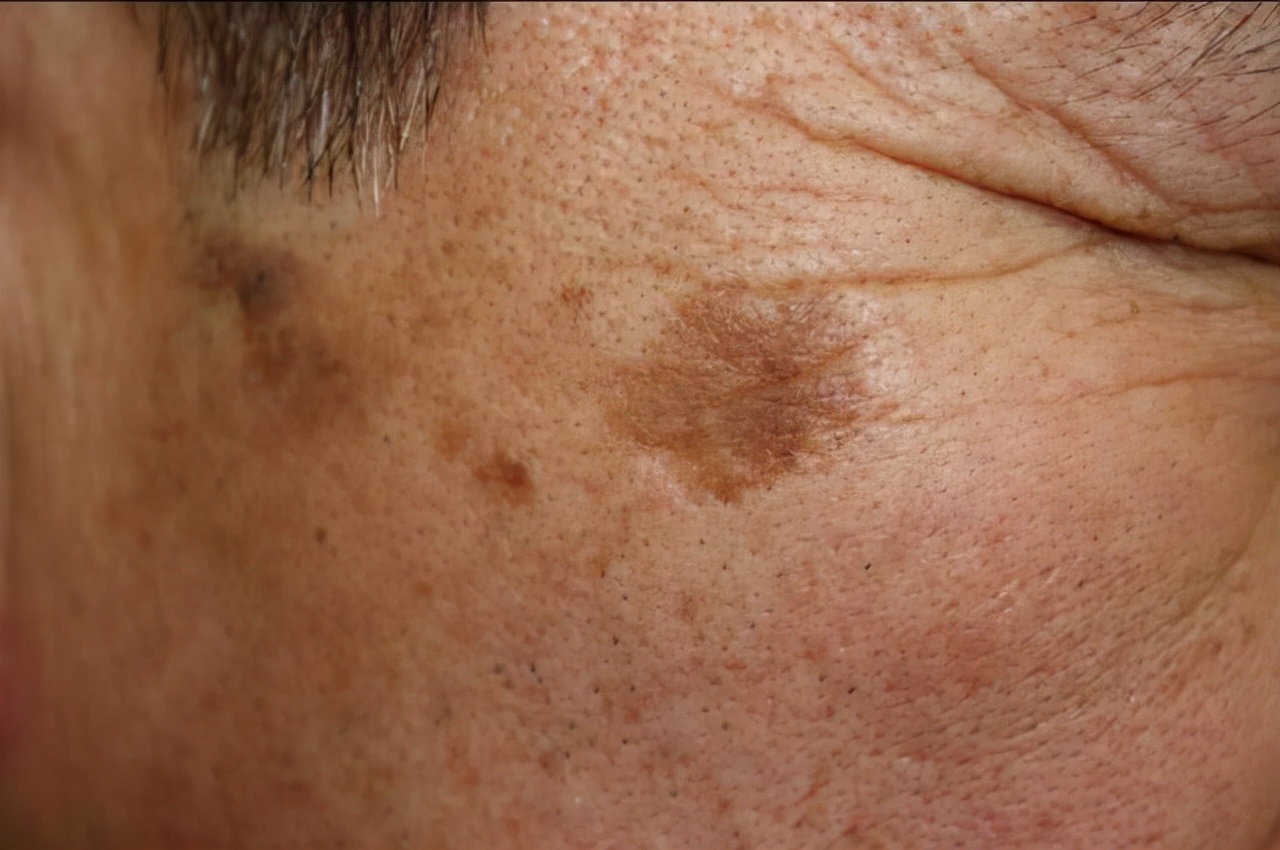 55岁老长老年斑怎么预防治疗,为什么会出现老年斑怎么治疗最好