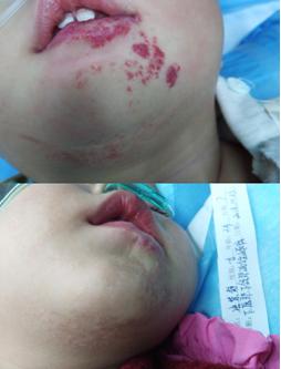 血管瘤长在婴儿上嘴唇里怎么治疗,婴儿皮下长血管瘤治疗方法