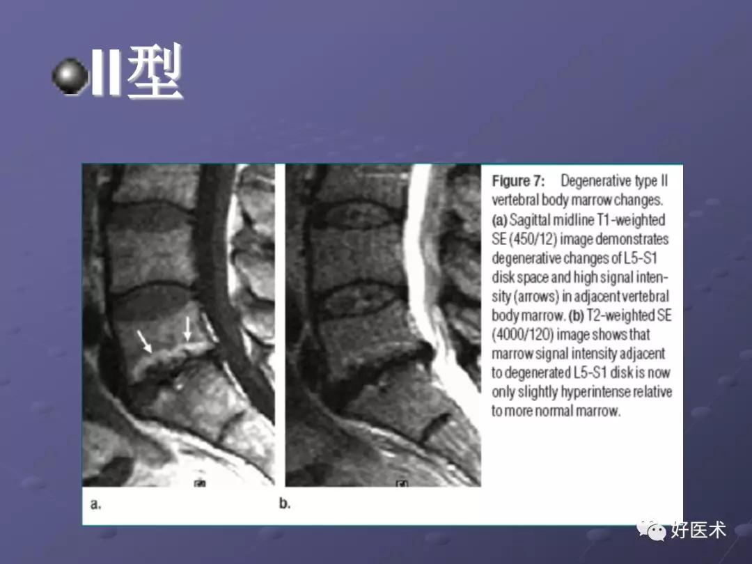 脊柱mri有哪些特点,乳腺疾病的mri诊断及鉴别