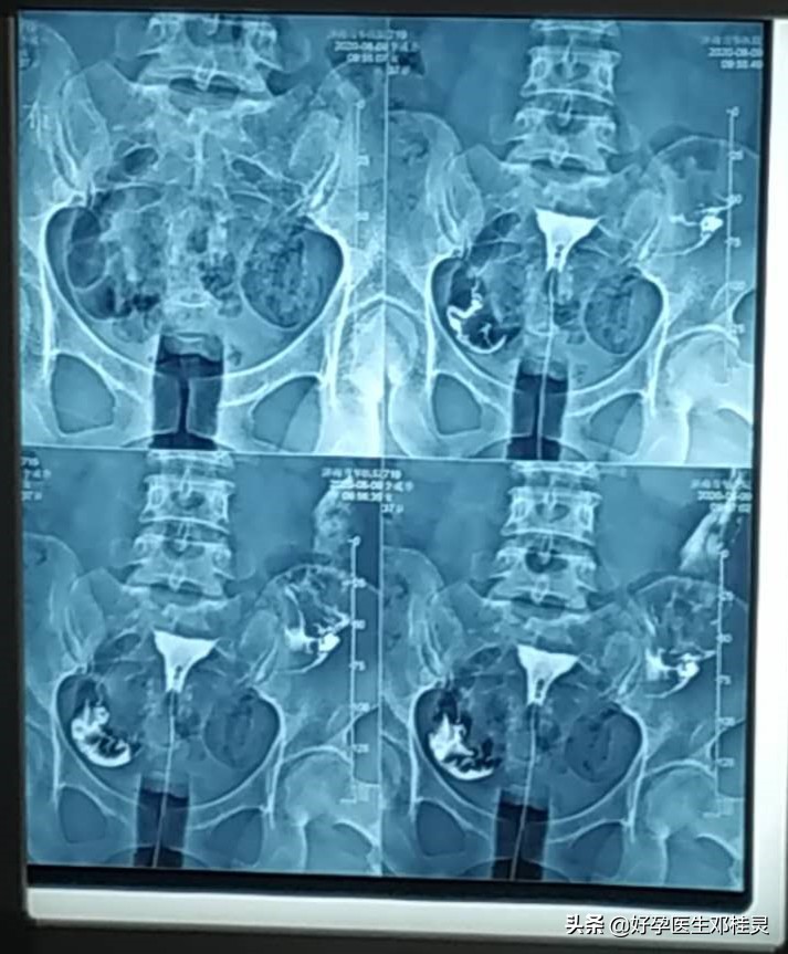 做了输卵管造影后如何有效备孕,做完输卵管造影以后多久可以备孕