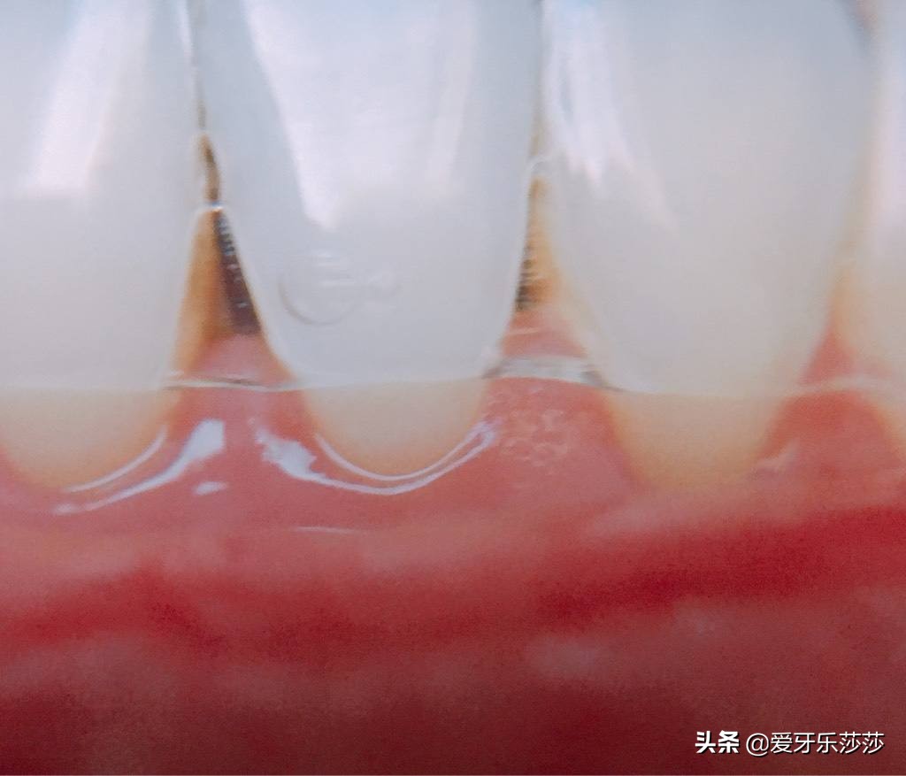 牙齿矫正之后后出现黑三角怎么办？