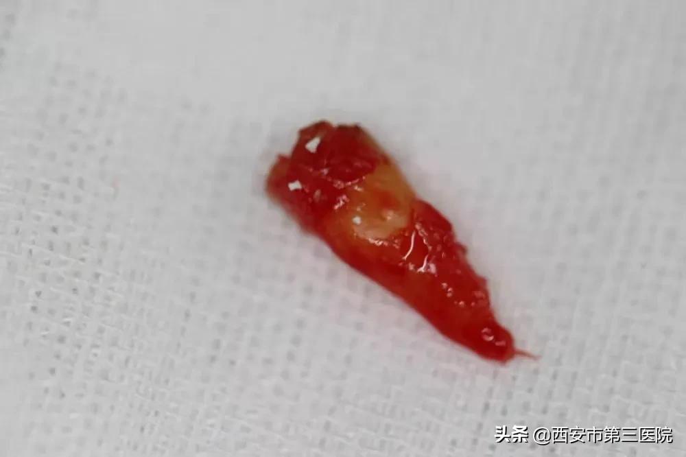 关注口腔健康的策划案例,关注口腔健康数字化种植牙