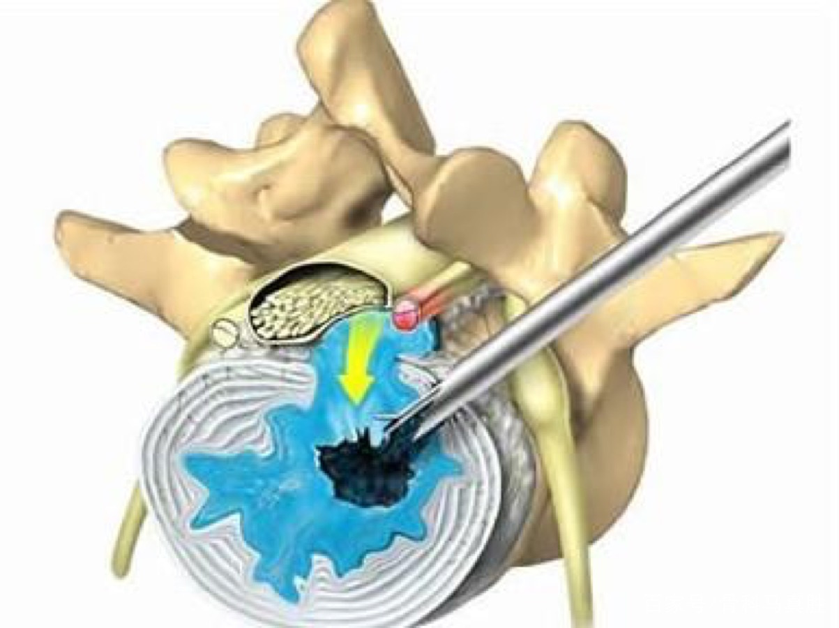 腰椎开放手术好还是微创手术好,腰椎间盘突出微创手术是几级手术