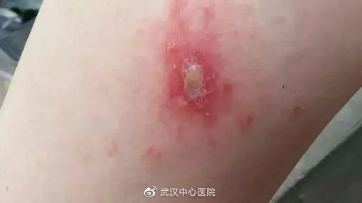 遇到这些虫子千万别拍它,提高警惕遇到这些虫子千万别乱拍